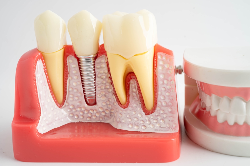 Dental implants