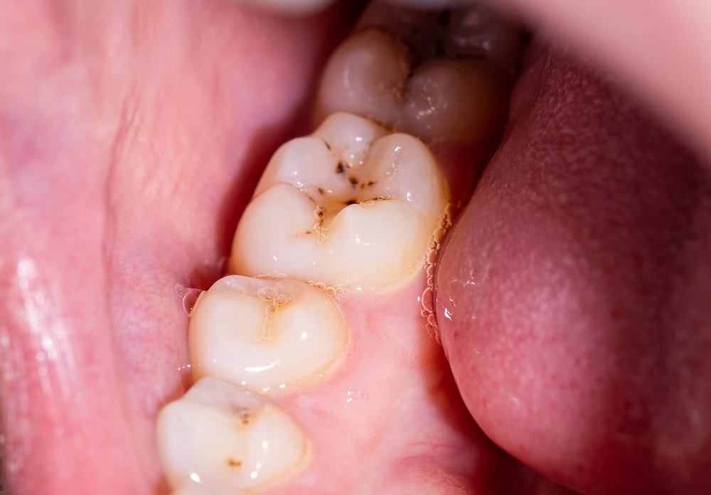 Can You Get a Cavity Under a Dental Crown?
