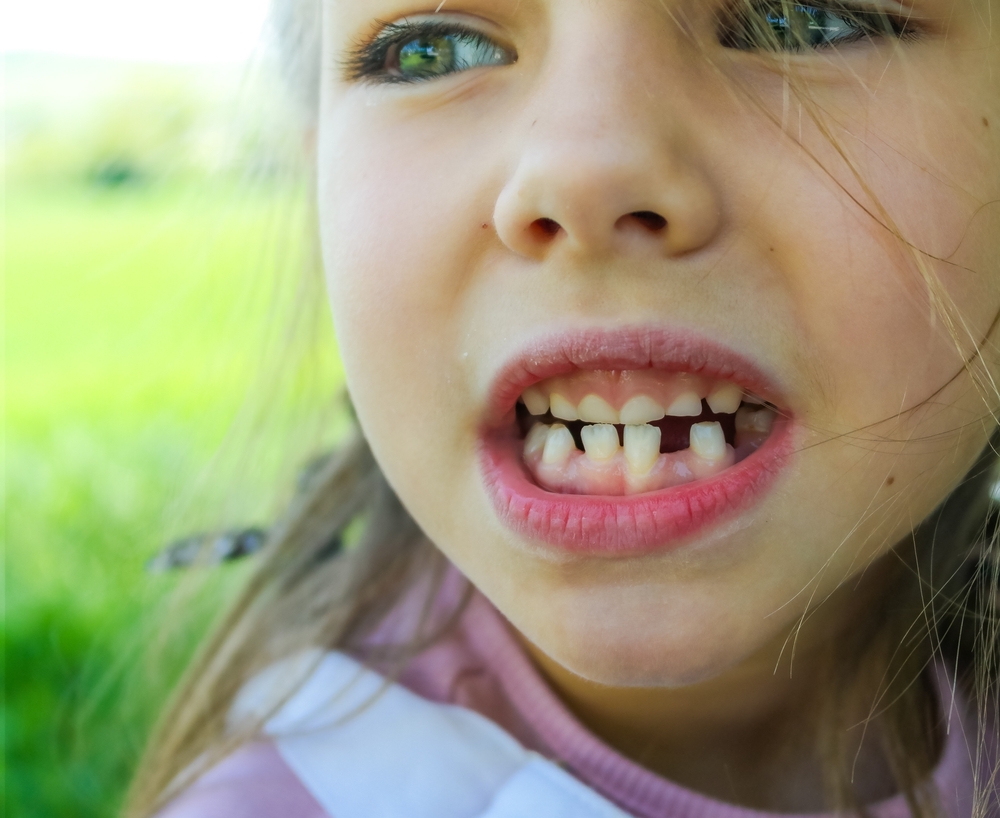 The smile of a cute girl. Three teeth have fallen out, there is little space for molars. Milk teeth fall out. Close-up.