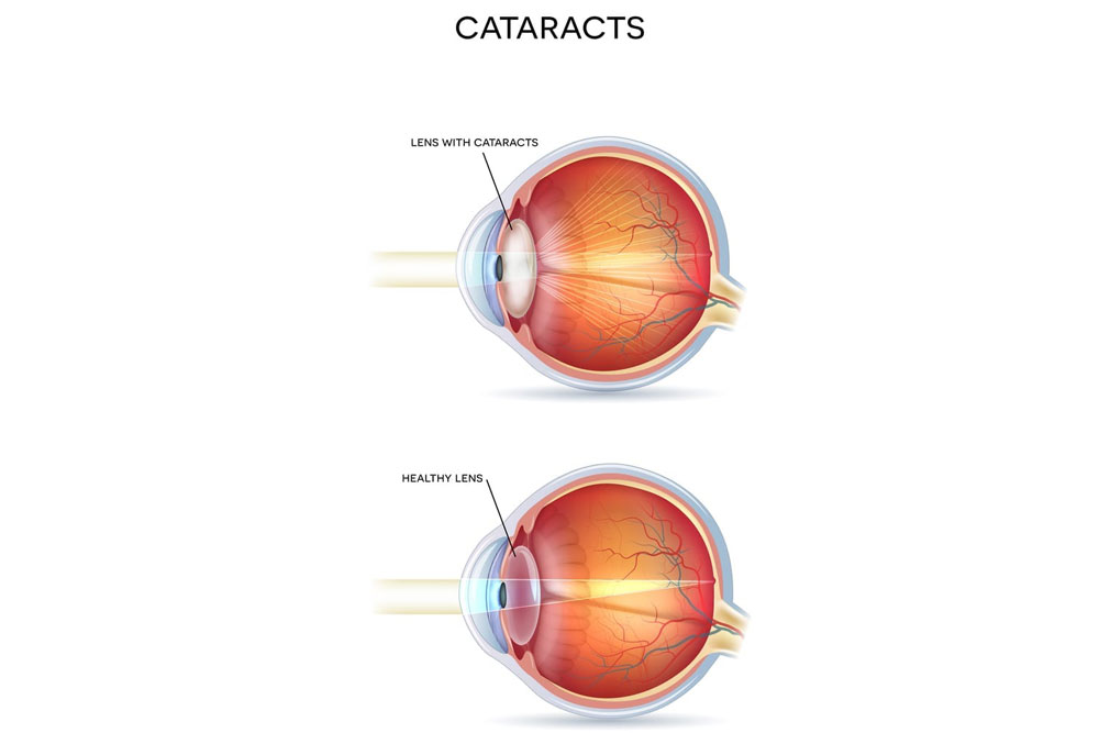 Cataracts Evaluations