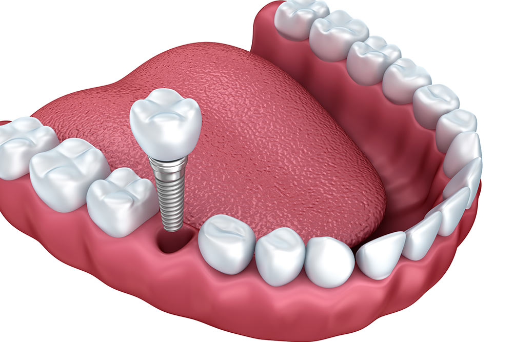3d lower teeth and dental implant