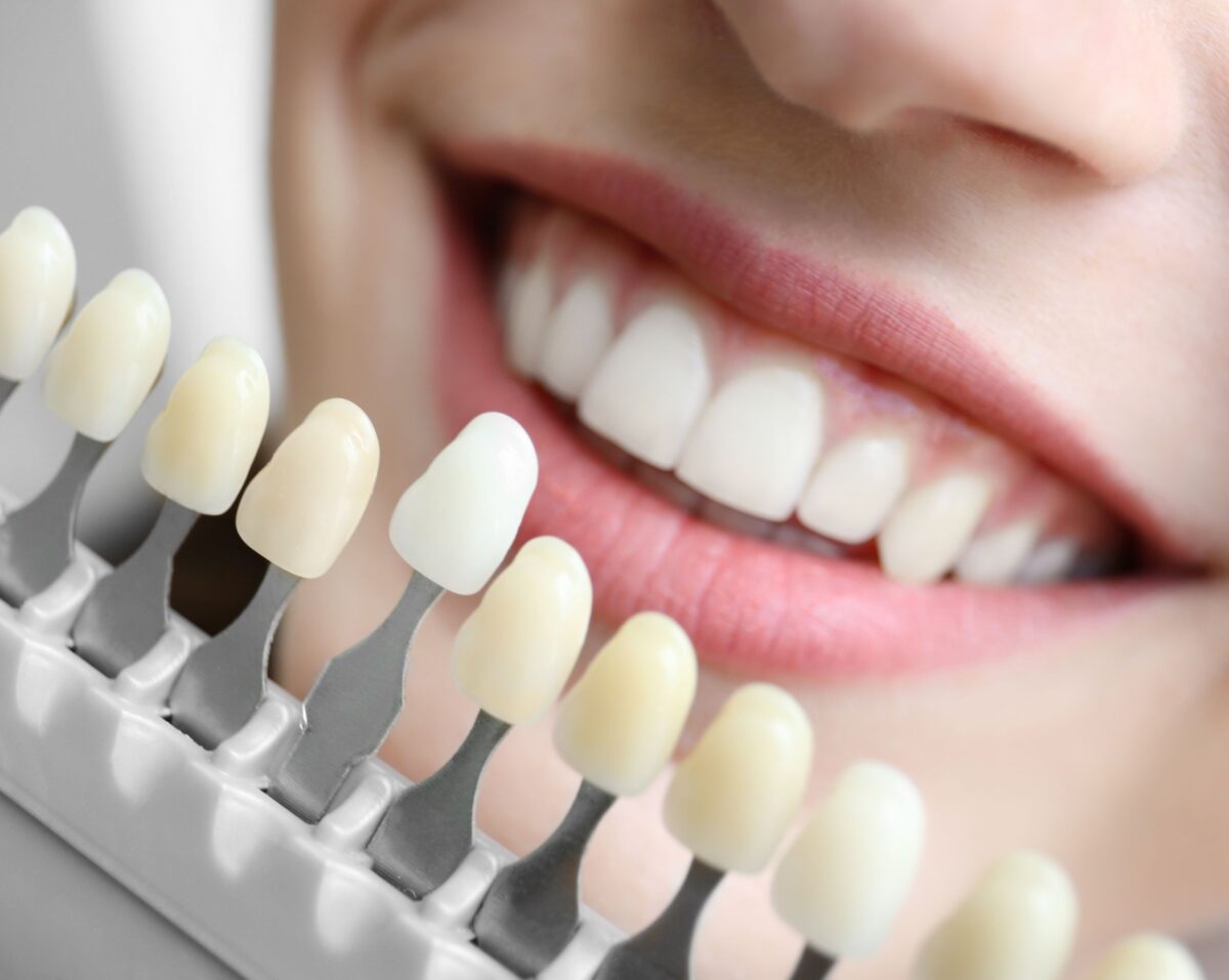 Close up of a nice smile with a tooth shade bar in front of it