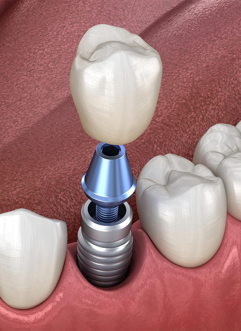 A 3D representation of a tooth implant being installed