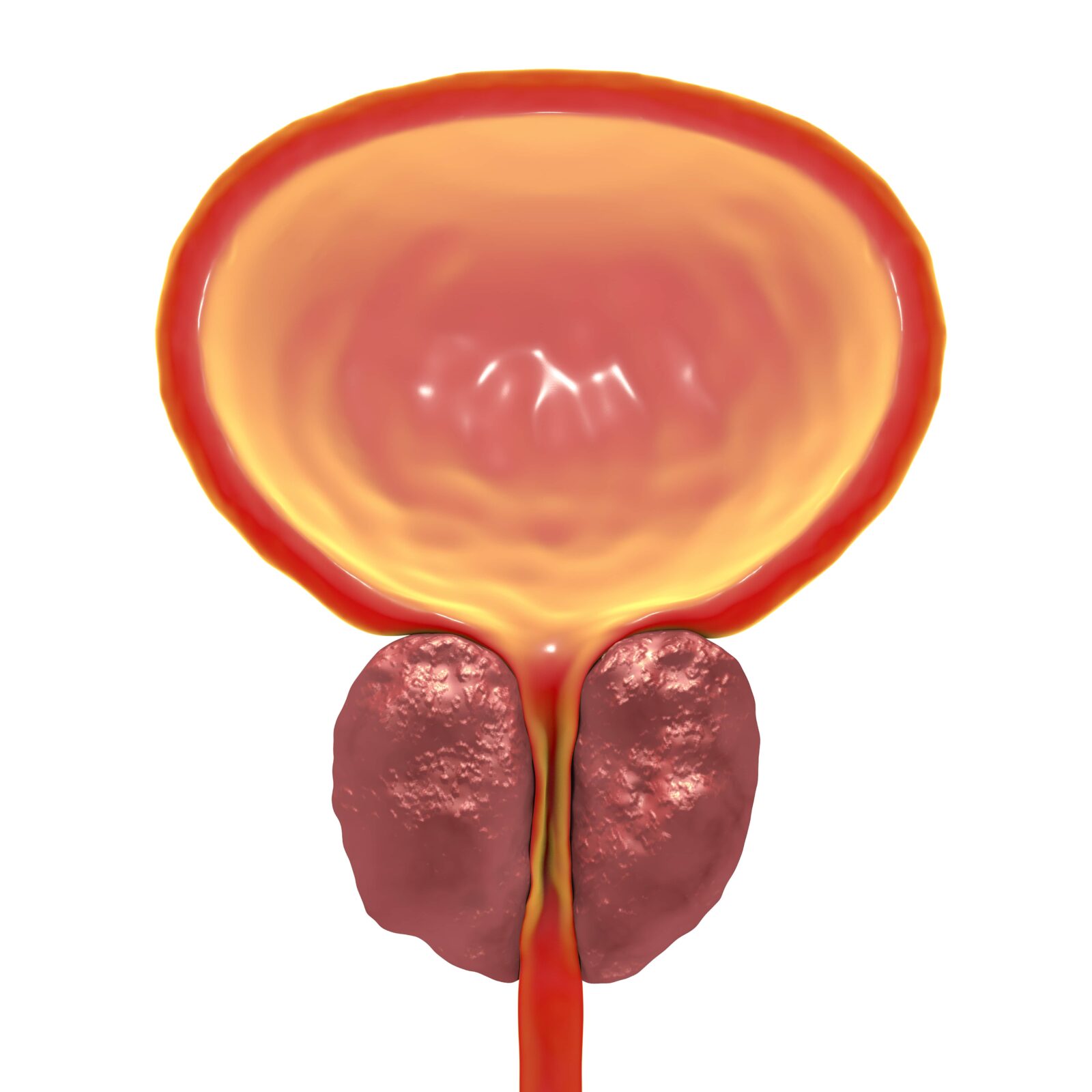 Benign prostatic hyperplasia