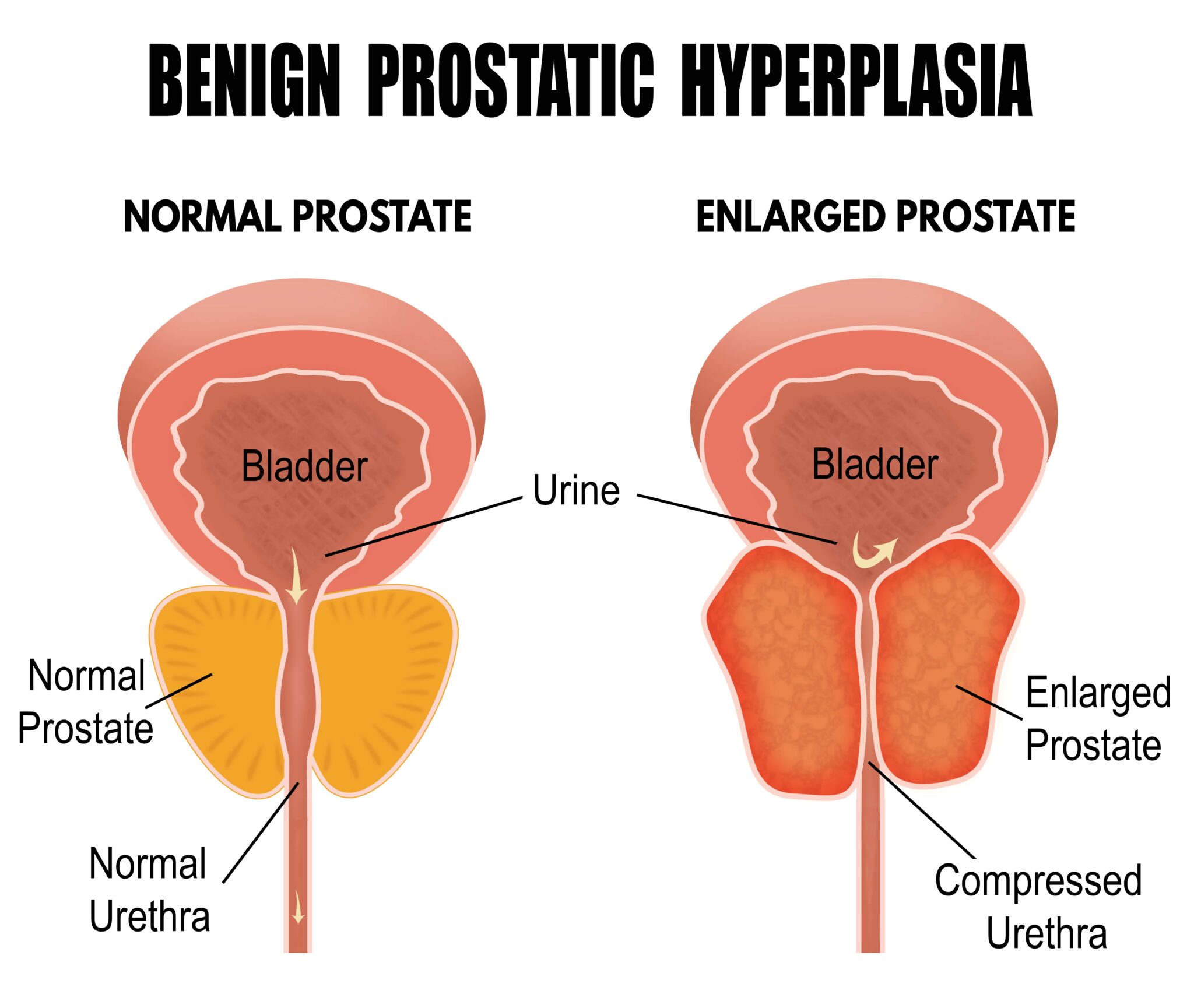 What Are Four Risk Factors For Bph New York City 1 Prostate Center 8800