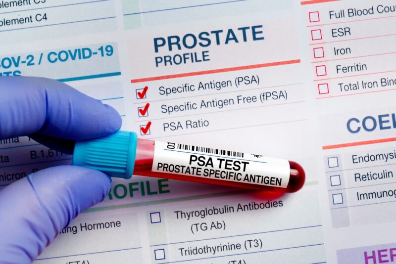 Blood sample tube for analysis of PSA Prostate Specific Antigen profile test in laborator