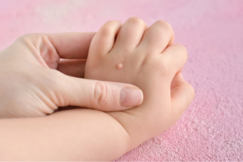 Small hand of a child affected with warts