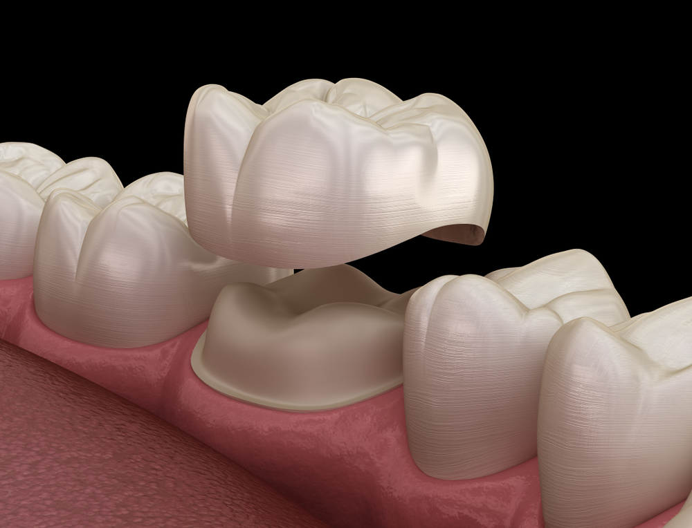 Model of a Dental Crown being placed on a tooth