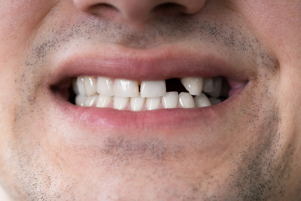 A person smiling with a missing tooth possibly in need of a restorations