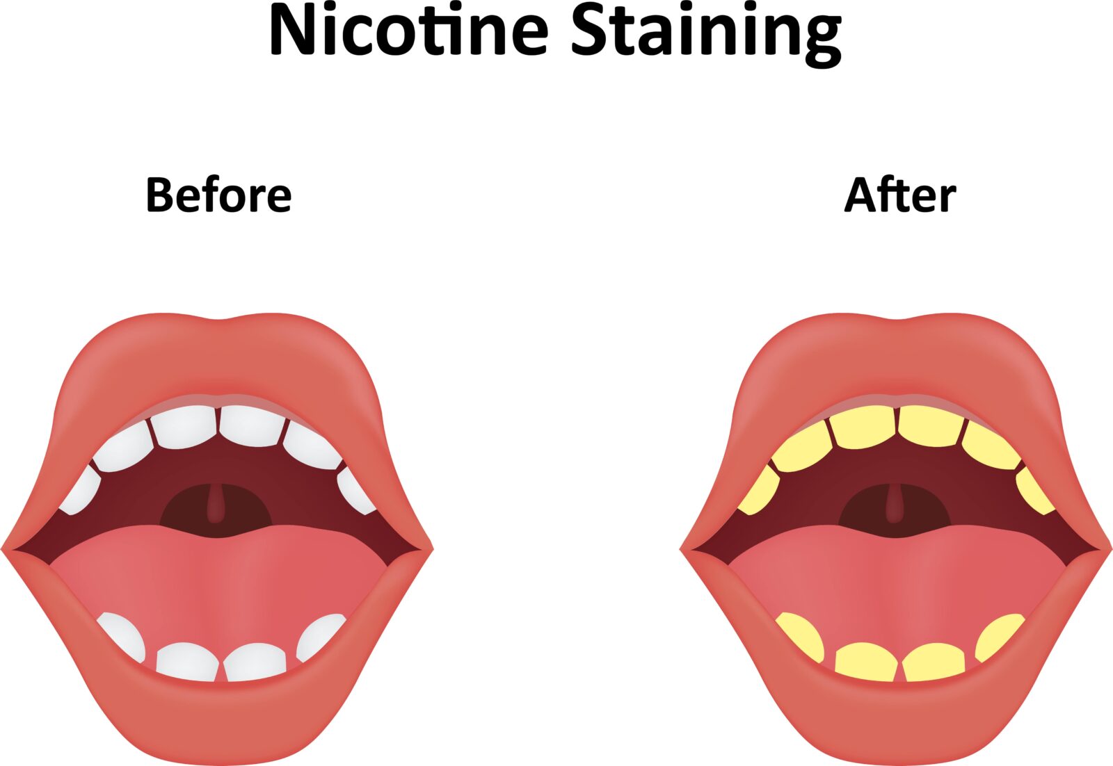 before and after nicotine stains