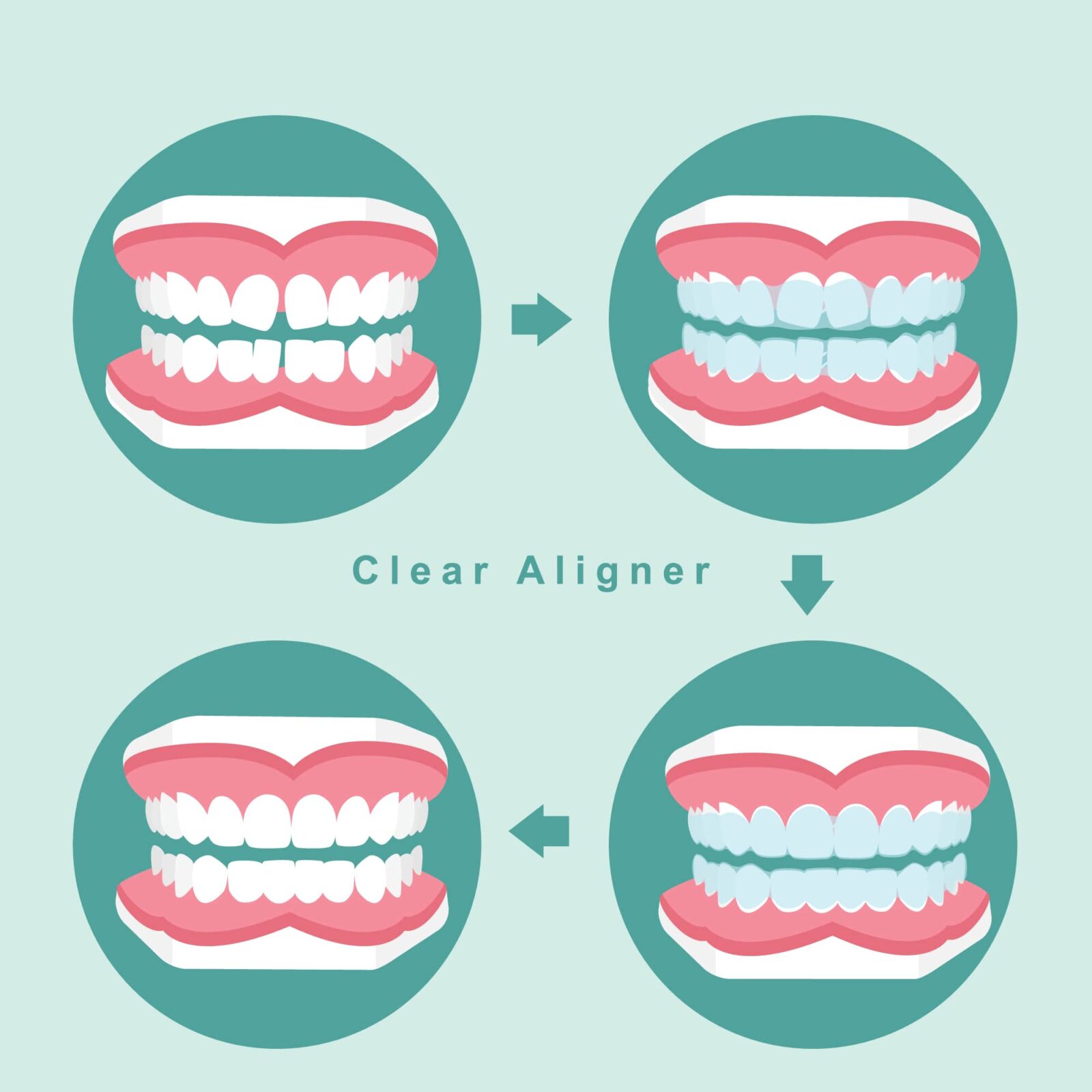 image showing the progression of orthodontic treatment with clear aligners