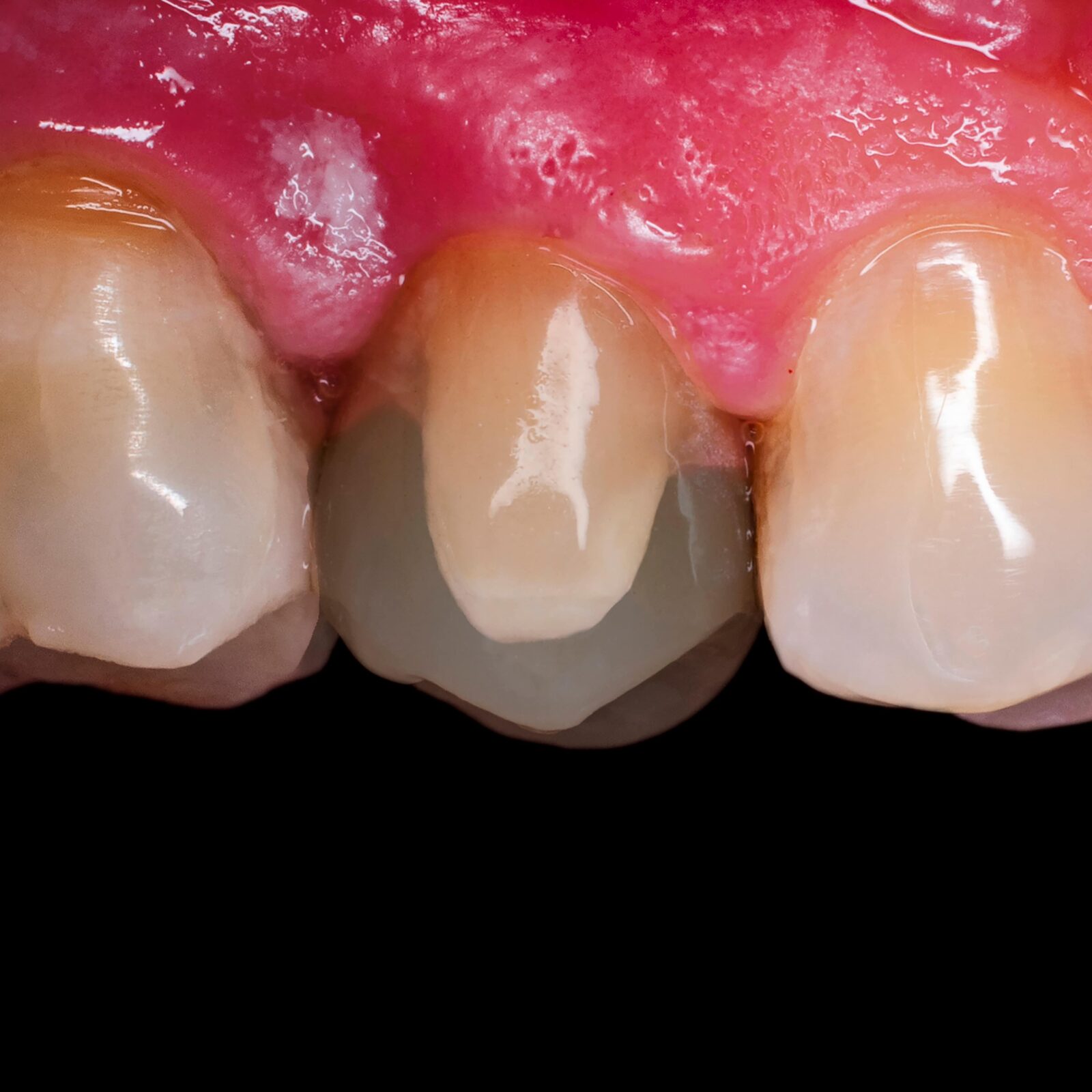 shaded full sized tooth restoration shown over a broken tooth piece