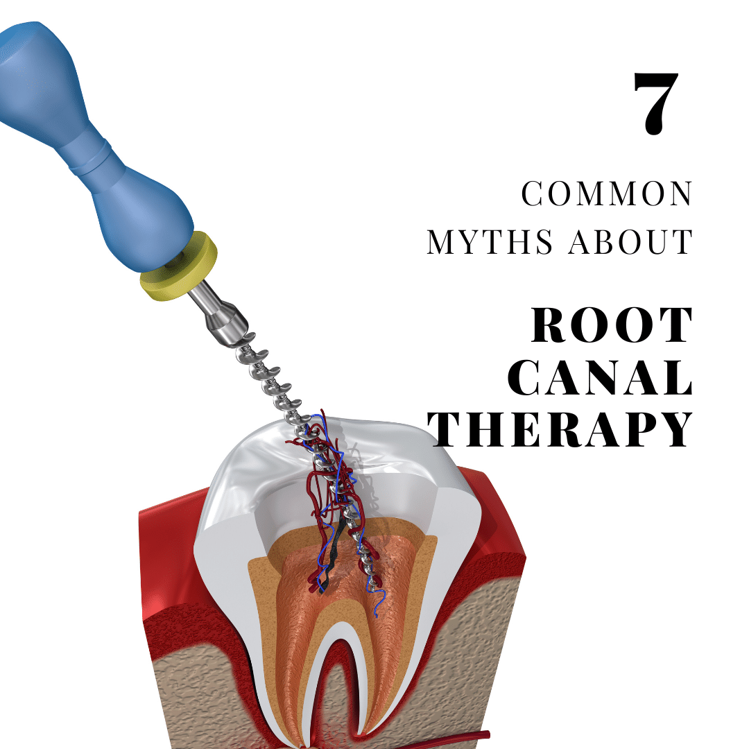 7 Common myths about root canal therapy
