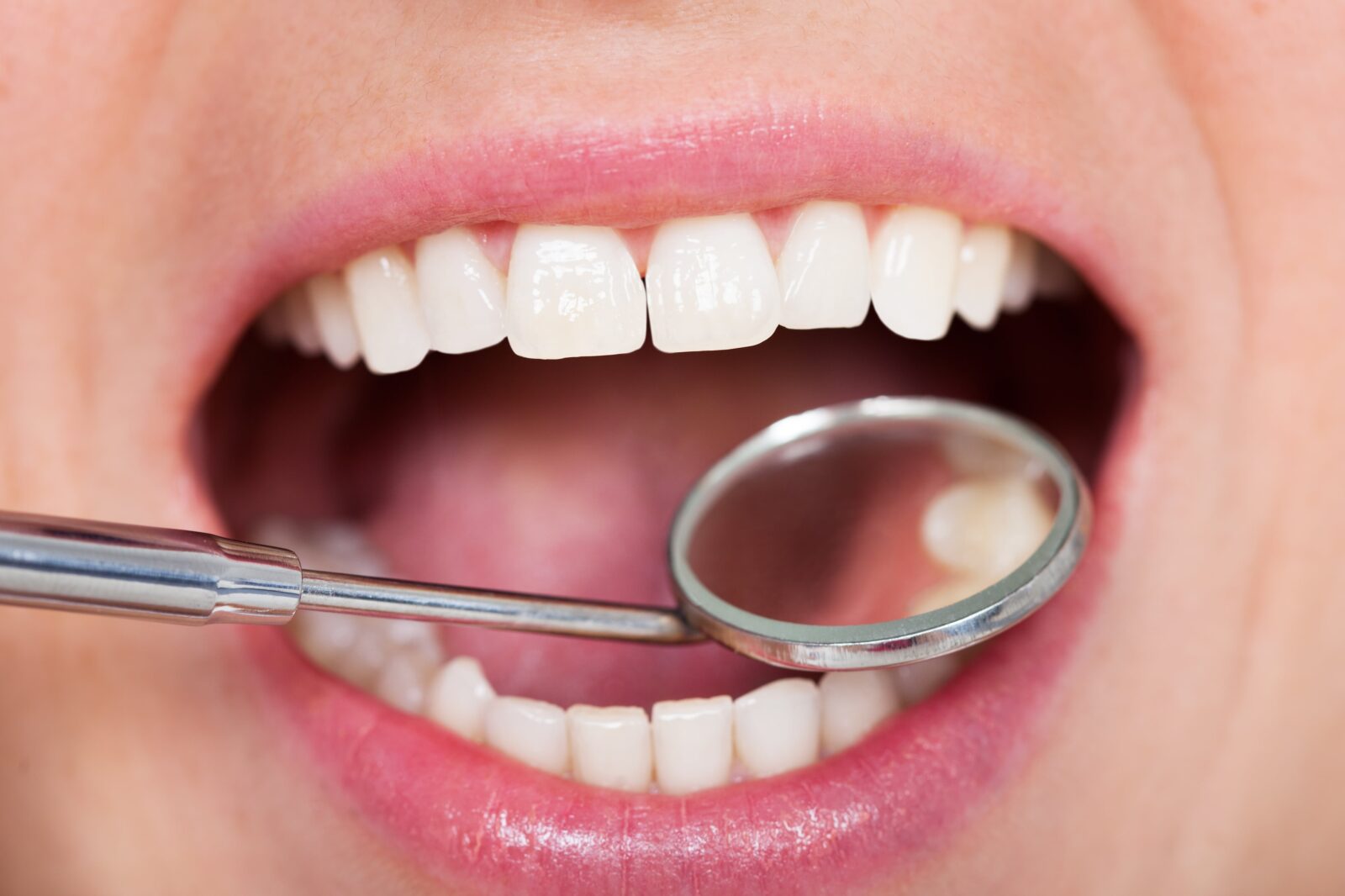 dental mirror in patient's mouth