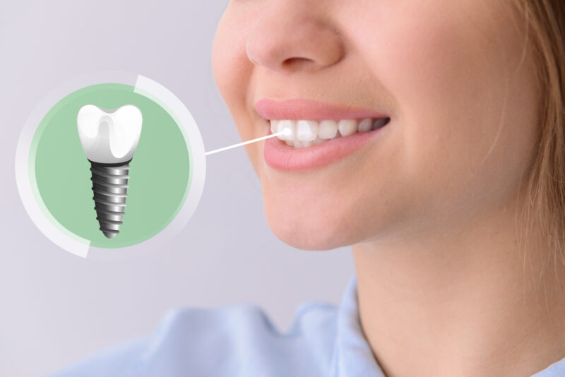 12 Fun Facts About Dental Implants