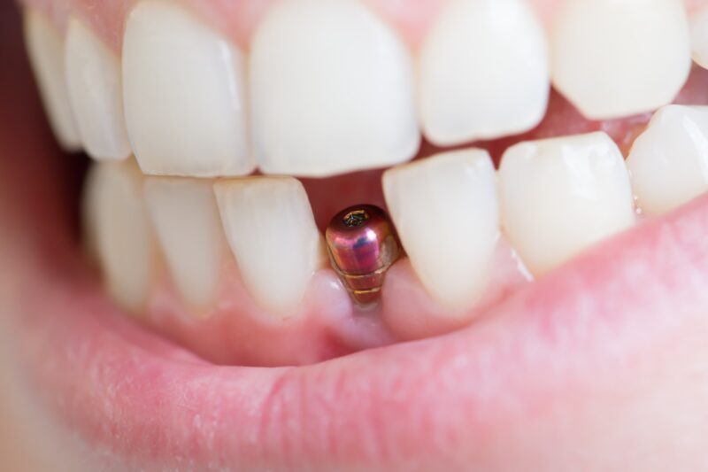 dental implant abutment sticking out of gums