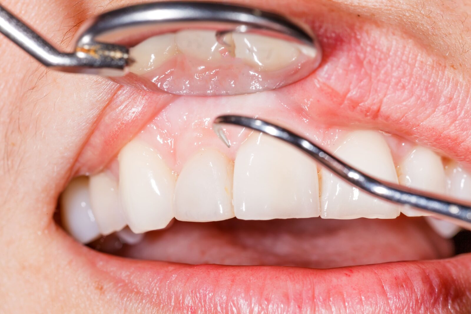 dental probe and mirror in front of teeth