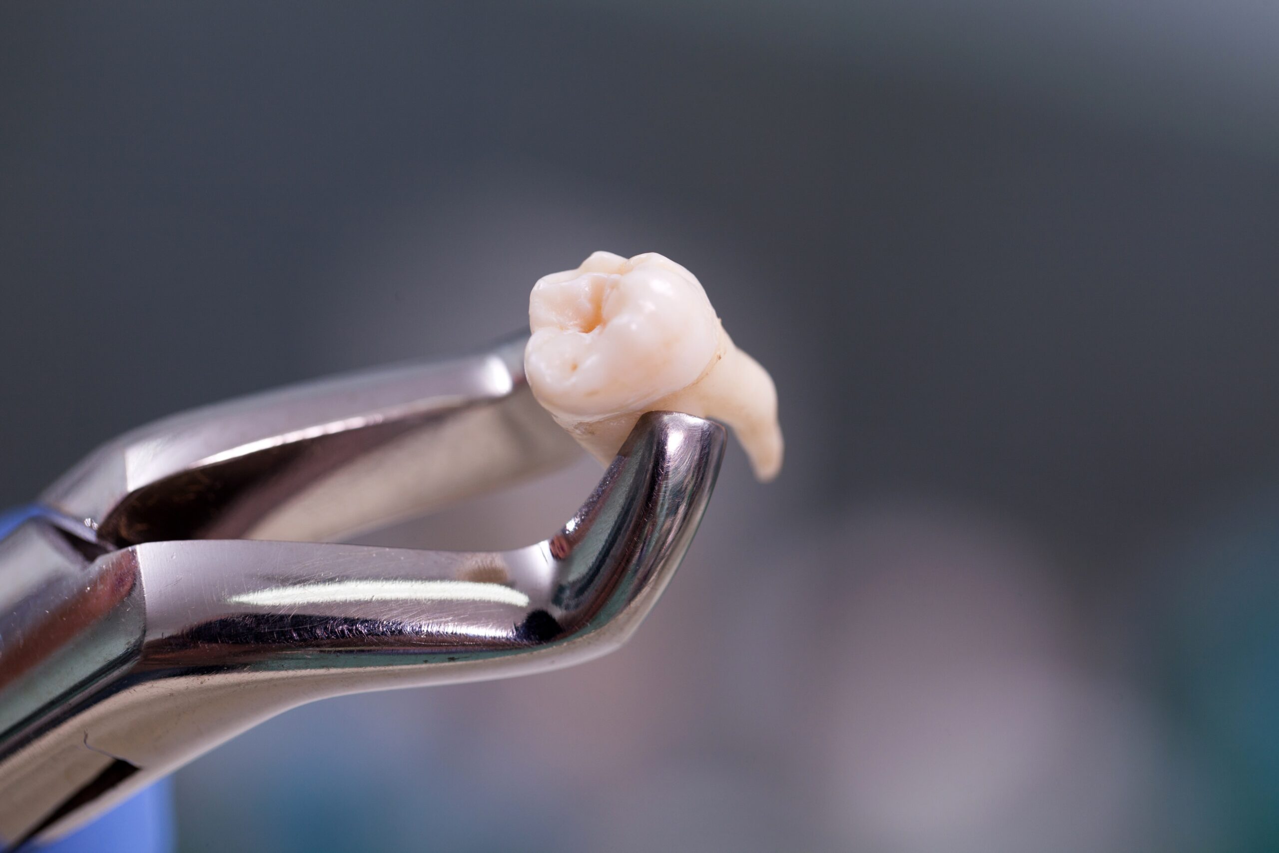 extracted tooth in forceps