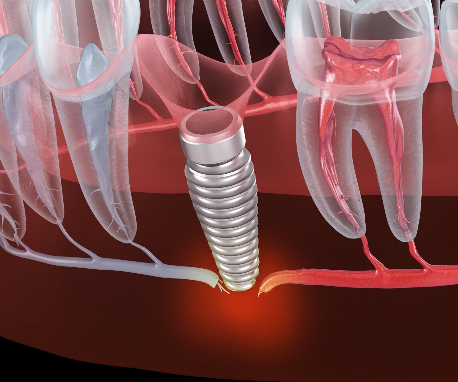Dental Implant Problems and How to Fix Them Tallmadge, OH Sisko