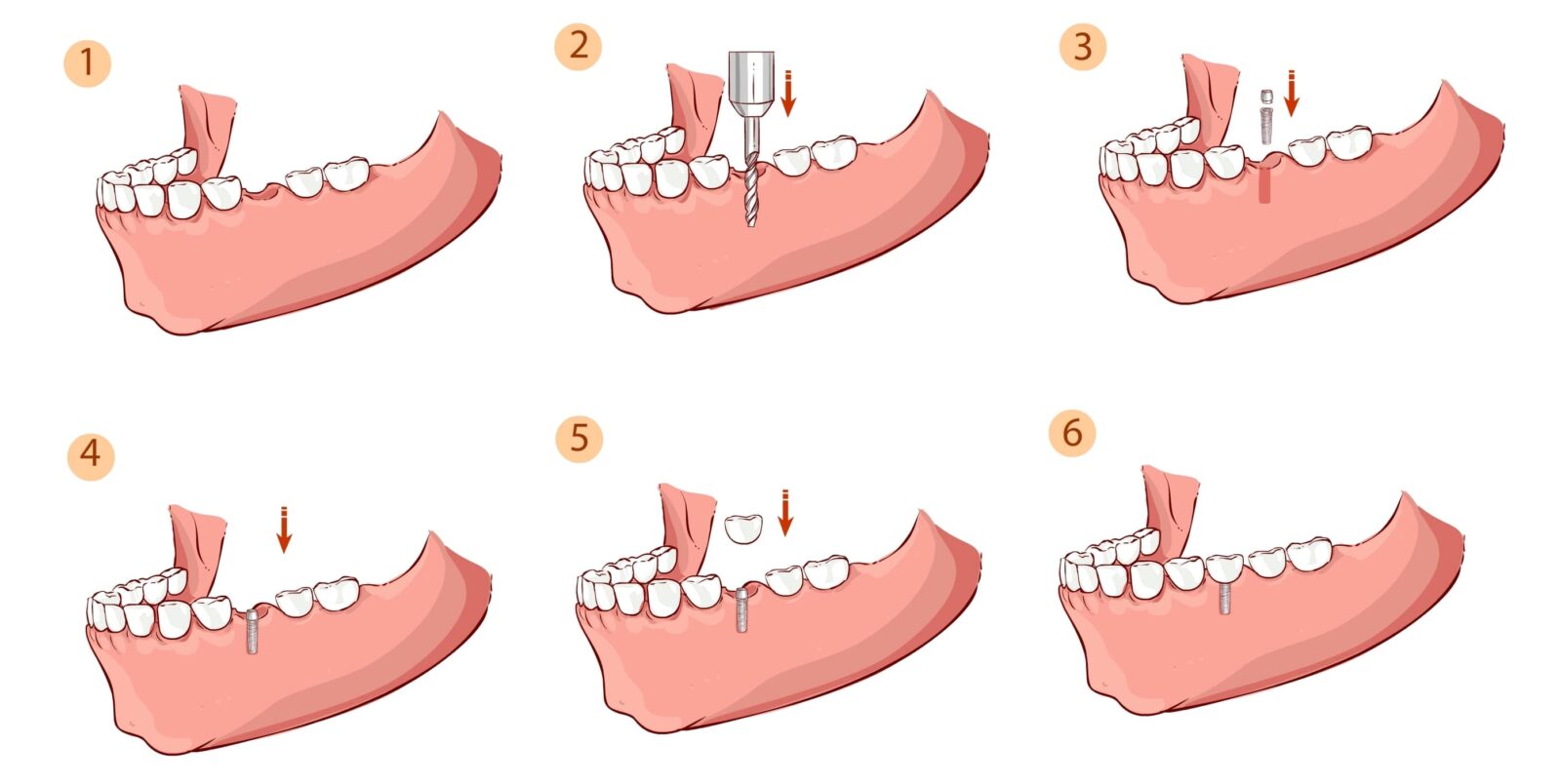 Dental Implant Problems And How To Fix Them Tallmadge Oh Sisko