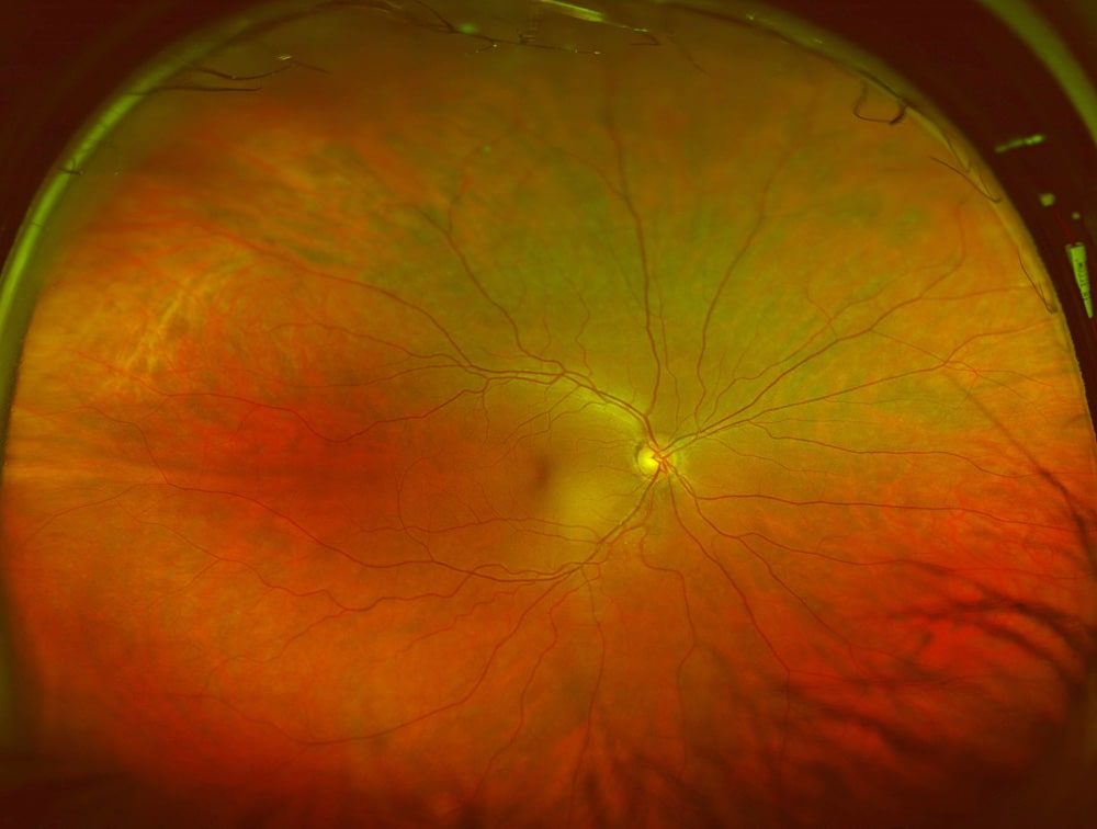 Healthy Retina