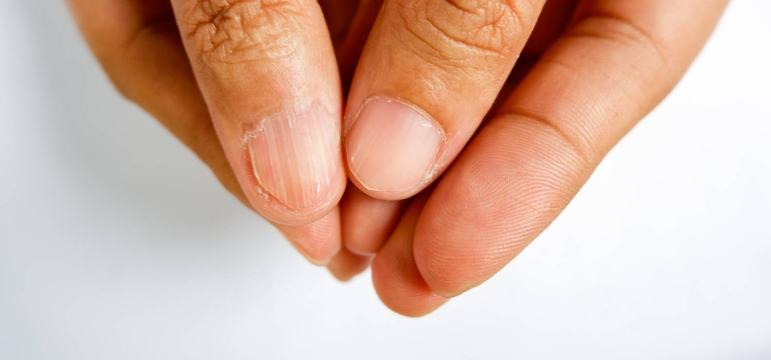 Image Gallery: Spoon‐shaped nails in an 11‐year‐old boy - Calleja‐Algarra -  2019 - British Journal of Dermatology - Wiley Online Library