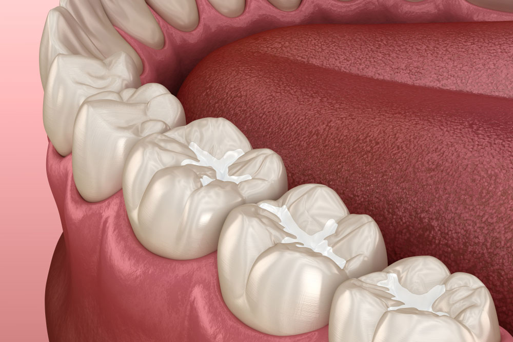 Molar Fissure dental fillings