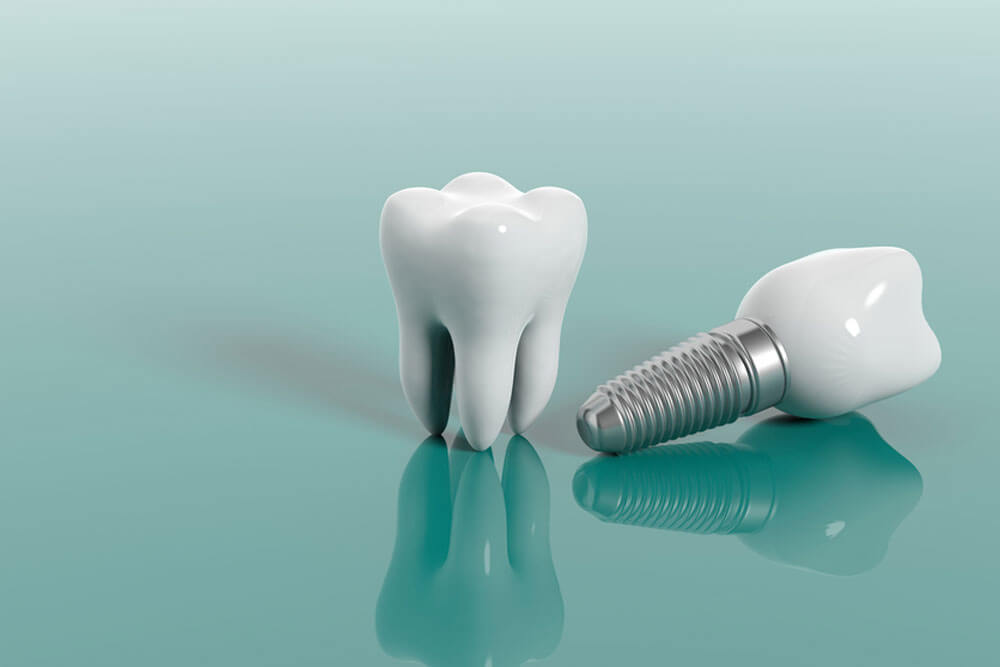 Tooth and dental implant