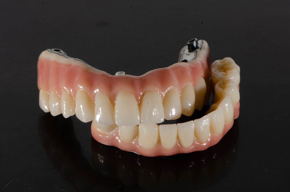 The all-on four dental prosthesis on implants