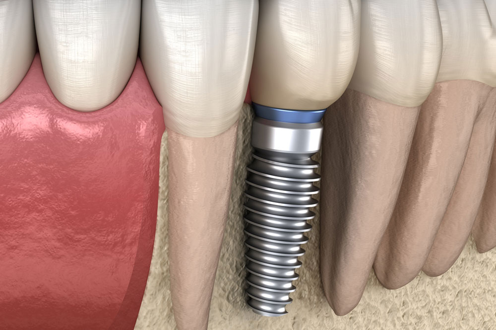 Premolar tooth recovery with implant