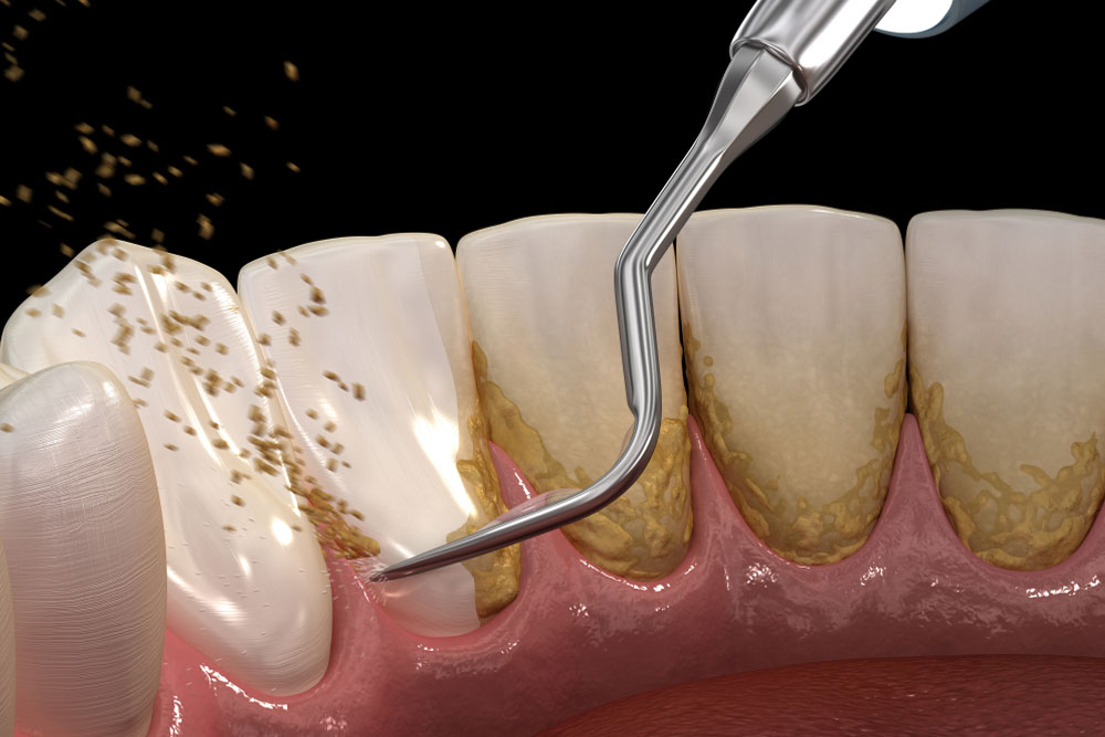 Scaling and root planing (conventional periodontal therapy)