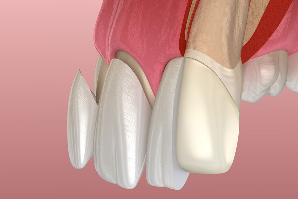 Veneer installation procedure over central incisor