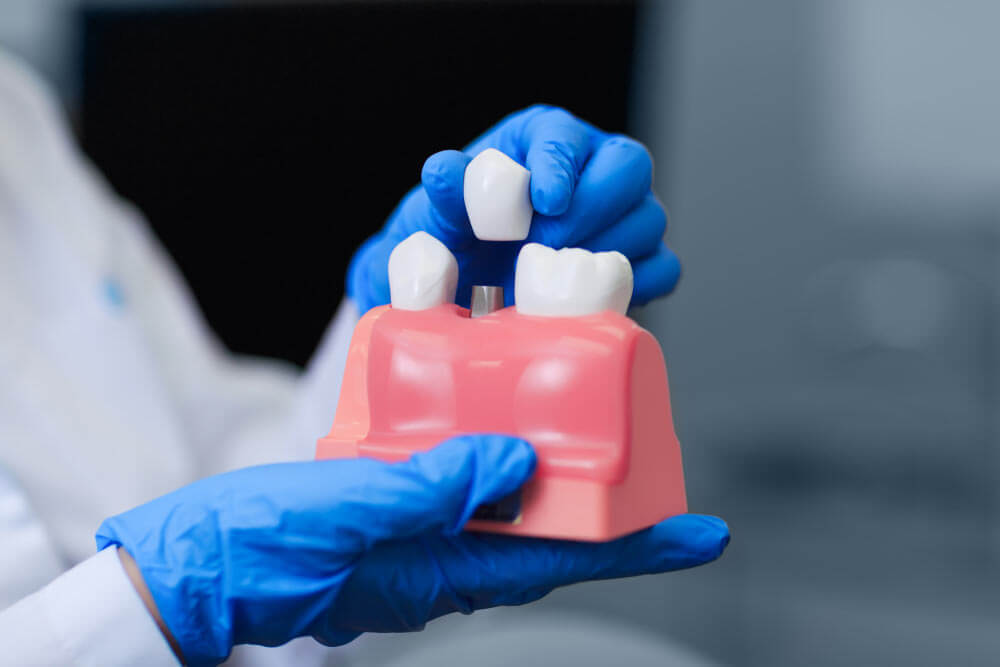 Doctor showing model of Dental Implants