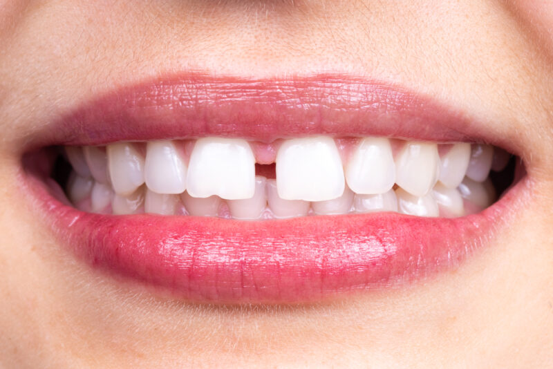 eliminating Gaps in teeth