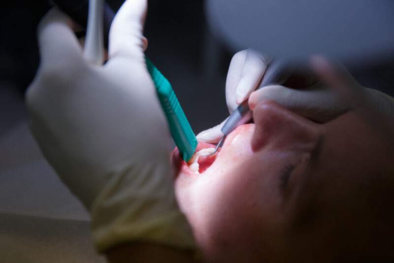 Shedding Light on Gum Disease Treatment: The Role of Laser Therapy in LANAP