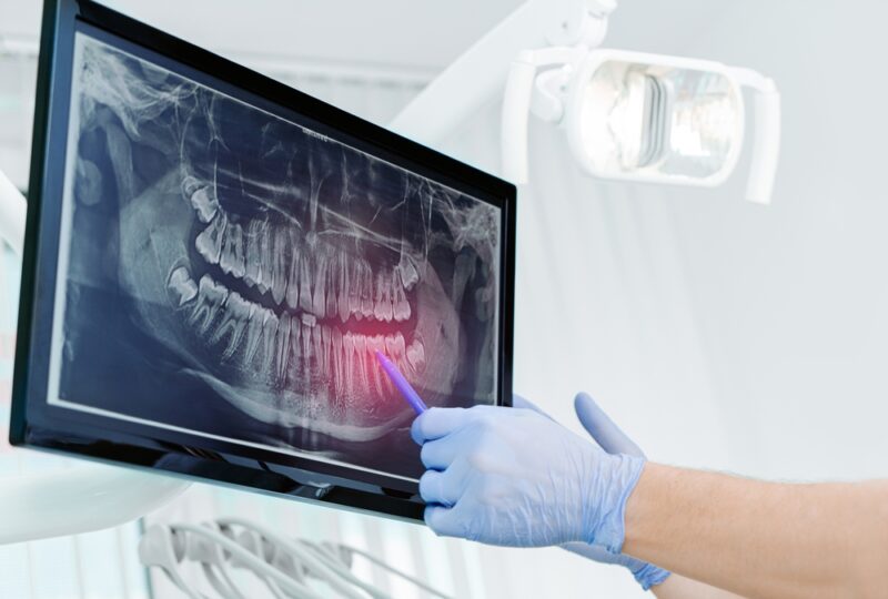 Why Dental X-Rays Are So Important
