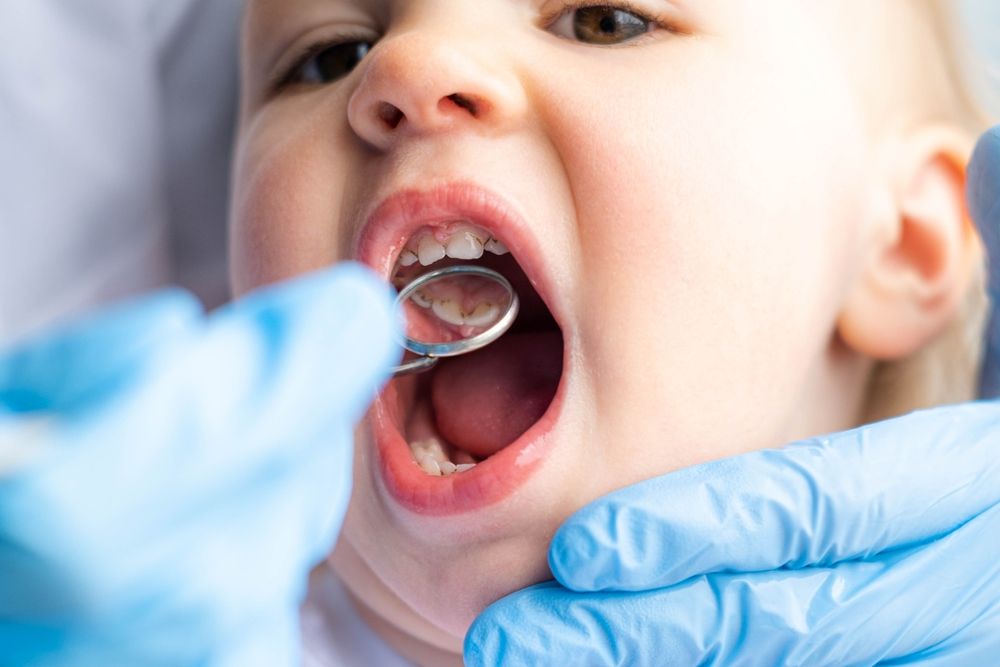 Closeup open mouth child and mirror in dentists hands in blue gloves