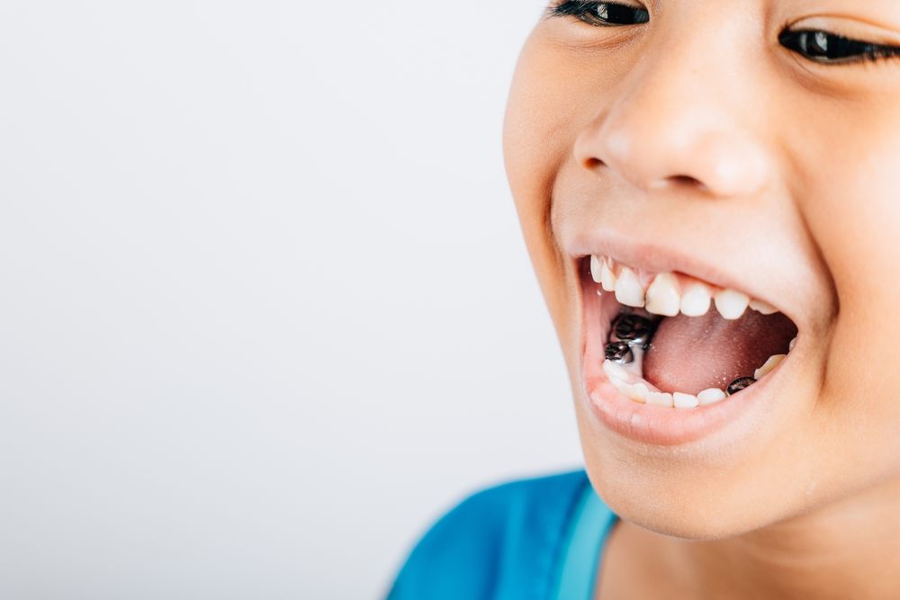 Dental image of a stainless steel crown a silver cap used for restoring children's teeth