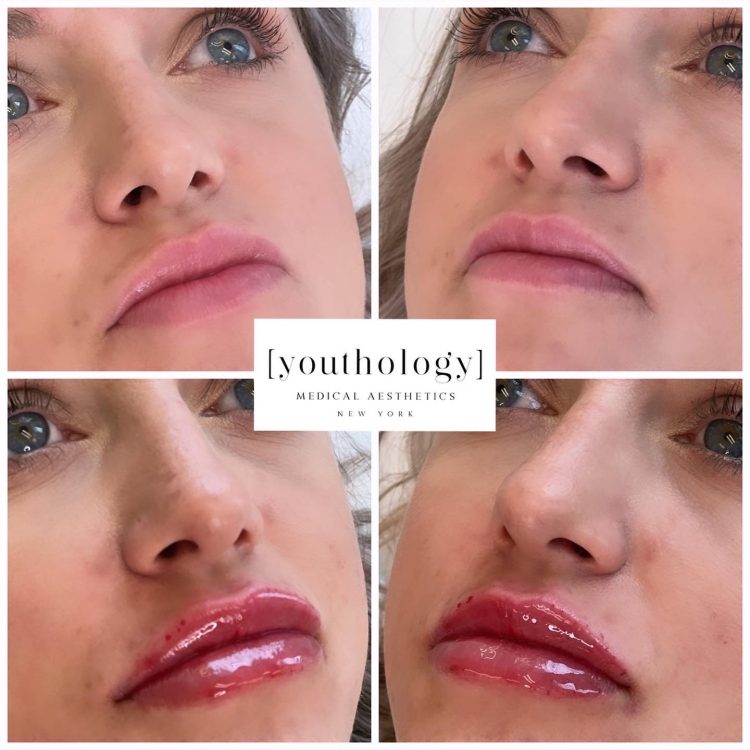 Lips treatment before after image