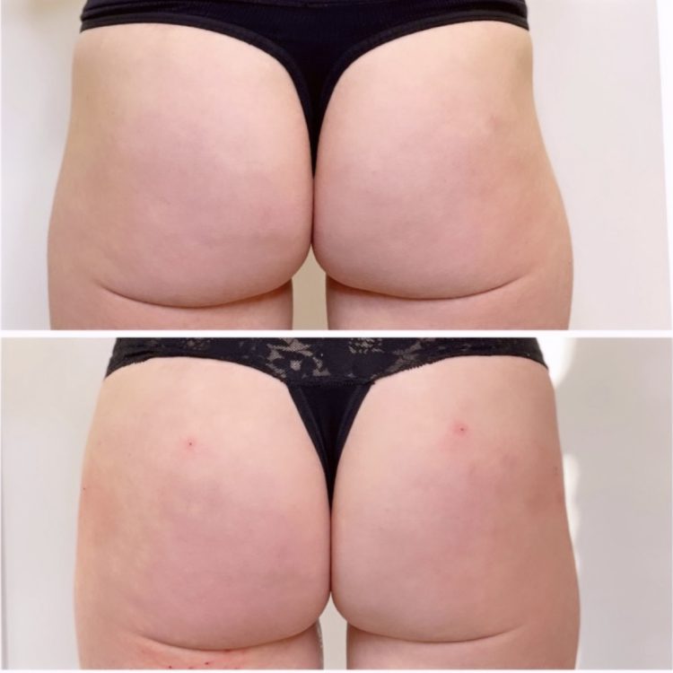 Buttock before after image
