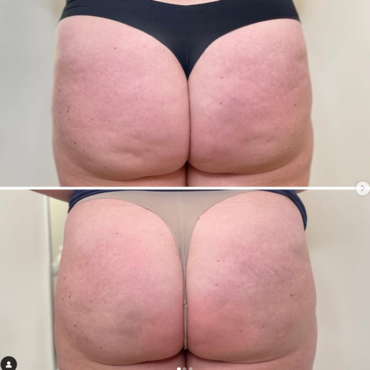 Buttock before after image