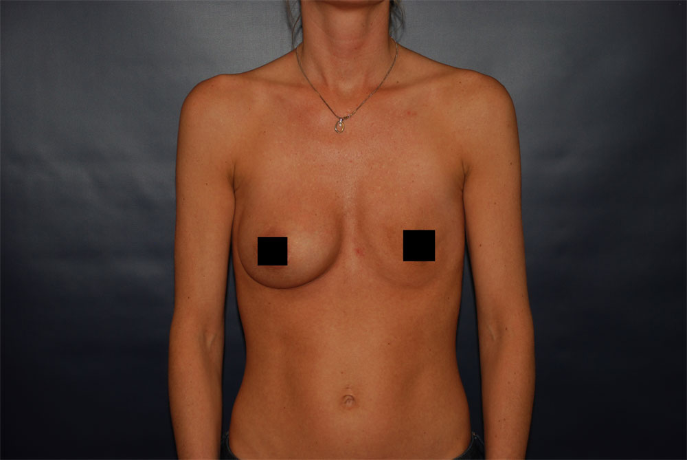 Breast Augmentation BEFORE