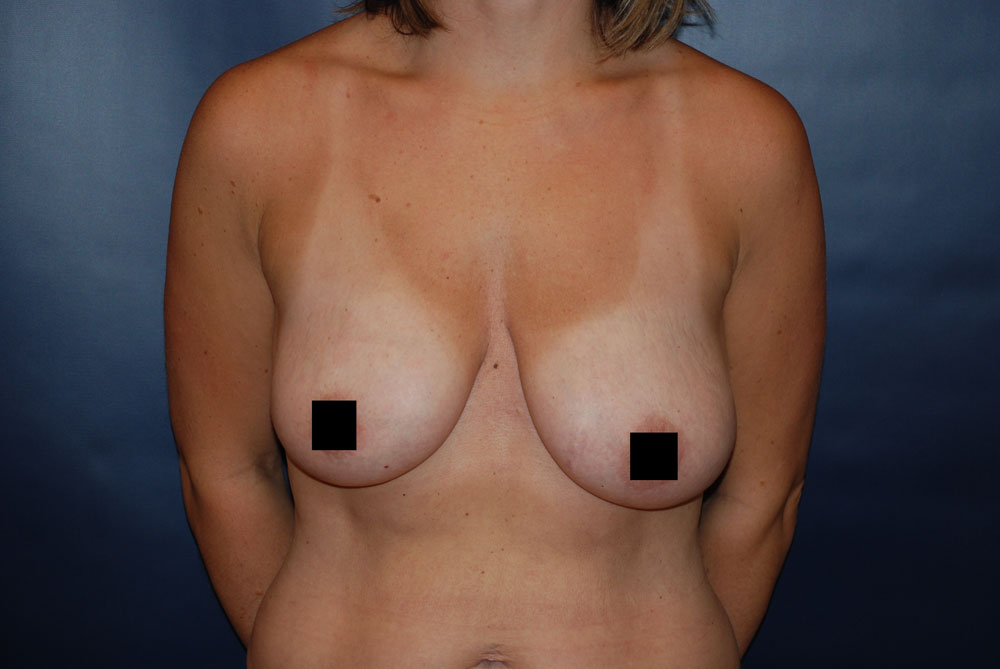 Breast Augmentation BEFORE
