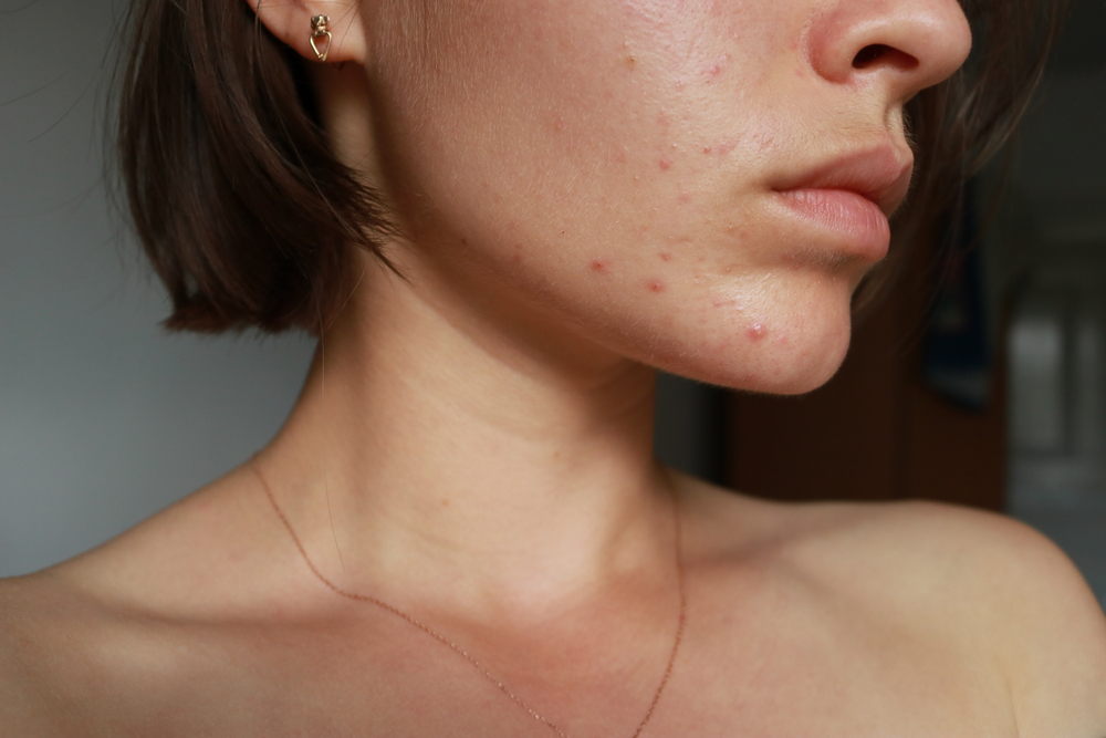 Could A Hormone Imbalance Be The Cause Of My Adult Acne?