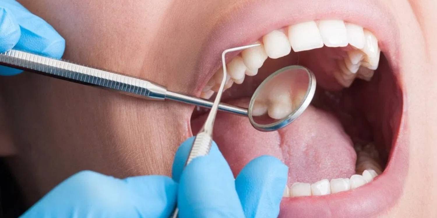 Periodontal Scaling