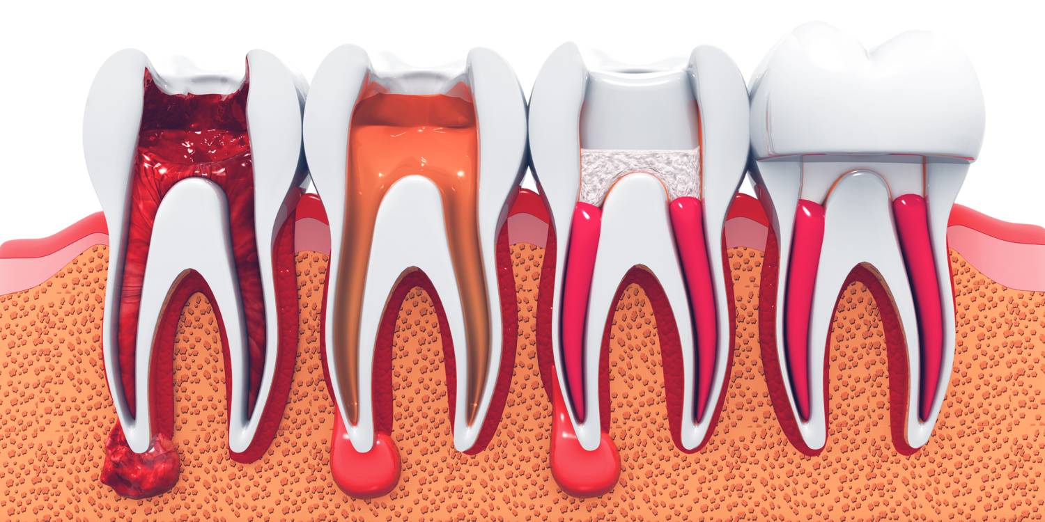 stages of root canal treatment