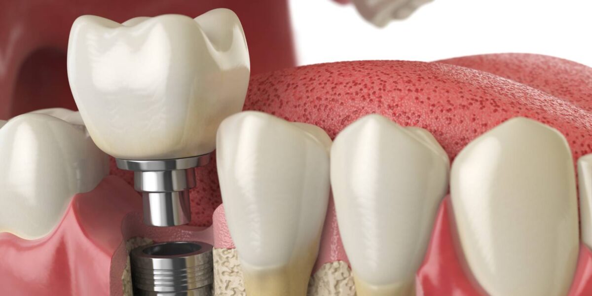 tooth dental implant