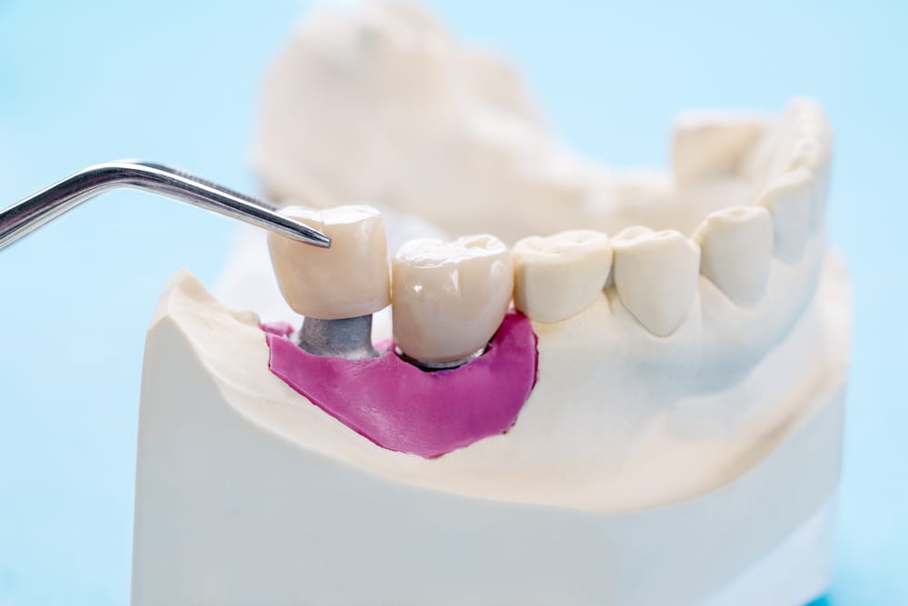 Tooth crown and bridge implant dentistry equipment and model express fix restoration