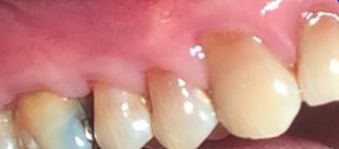 Restored gums after Pinhole treatment