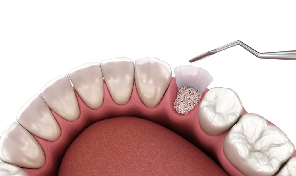 Augmentation Surgery - Adding bone after tooth extraction. 3D illustration